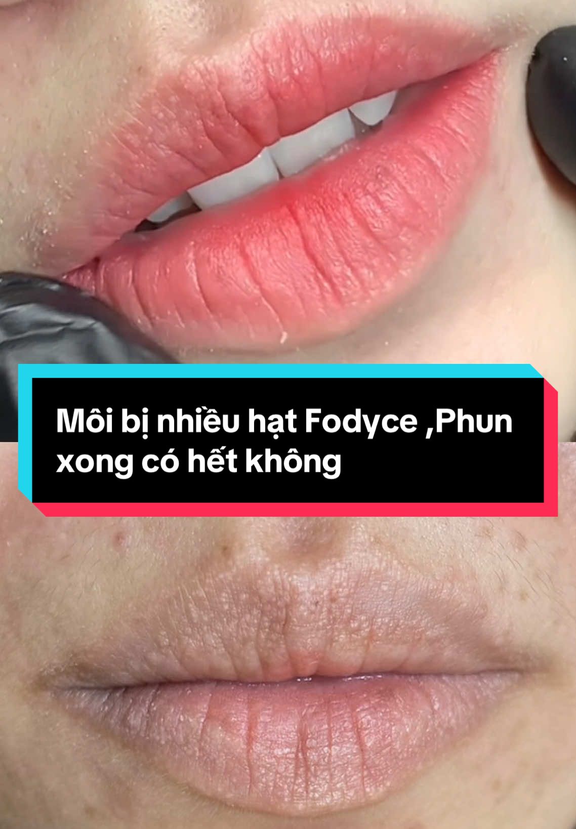 Trả lời @July ❌Đừng so sánh môi này với môi khác hãy so sánh với môi gốc của nó. Môi bị nhiều hạt Fodyce ,Phun xong có hết không 👇      ᵀᴴᴱ   ᴮᴱˢᵀ   ᴵˢ   ᶠᴼᴿ   ᵞᴼᵁ ———️ 𝐓 𝐇 𝐔 𝐎 𝐍 𝐆 𝐀 𝐁 𝐁 𝐘 ———— #xuhướng #viral #Sweetlips #phunmôicollagen #Pmu #MôiTựNhiên  #khửthâmmôinam  #Lipbeauty #chuyênphunmôi  #khửthâmmôi #ĐẹpMỗiNgày #LàmĐẹpAnToàn #BeautyTrend #KhửThâmMôiSiêuHay #Thươngabby #Chuyênkhửthâmmôi #phunmôigòvấp #khửthâmmôigòvấp #đàotaohocvienphunxamchuyennghiep #academypmu #kiếnthứcphunxăm 