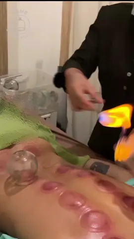 #cupping #masaj #manuelterapi 