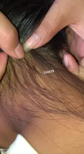 😱😱#omg #lice #liceremoval 