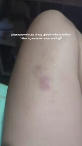 not me waking up with a bruise like i fought in my sleep #pms #randombruises #menstruation 