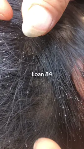 clean lice ##omg😱😱 #lice #trending #