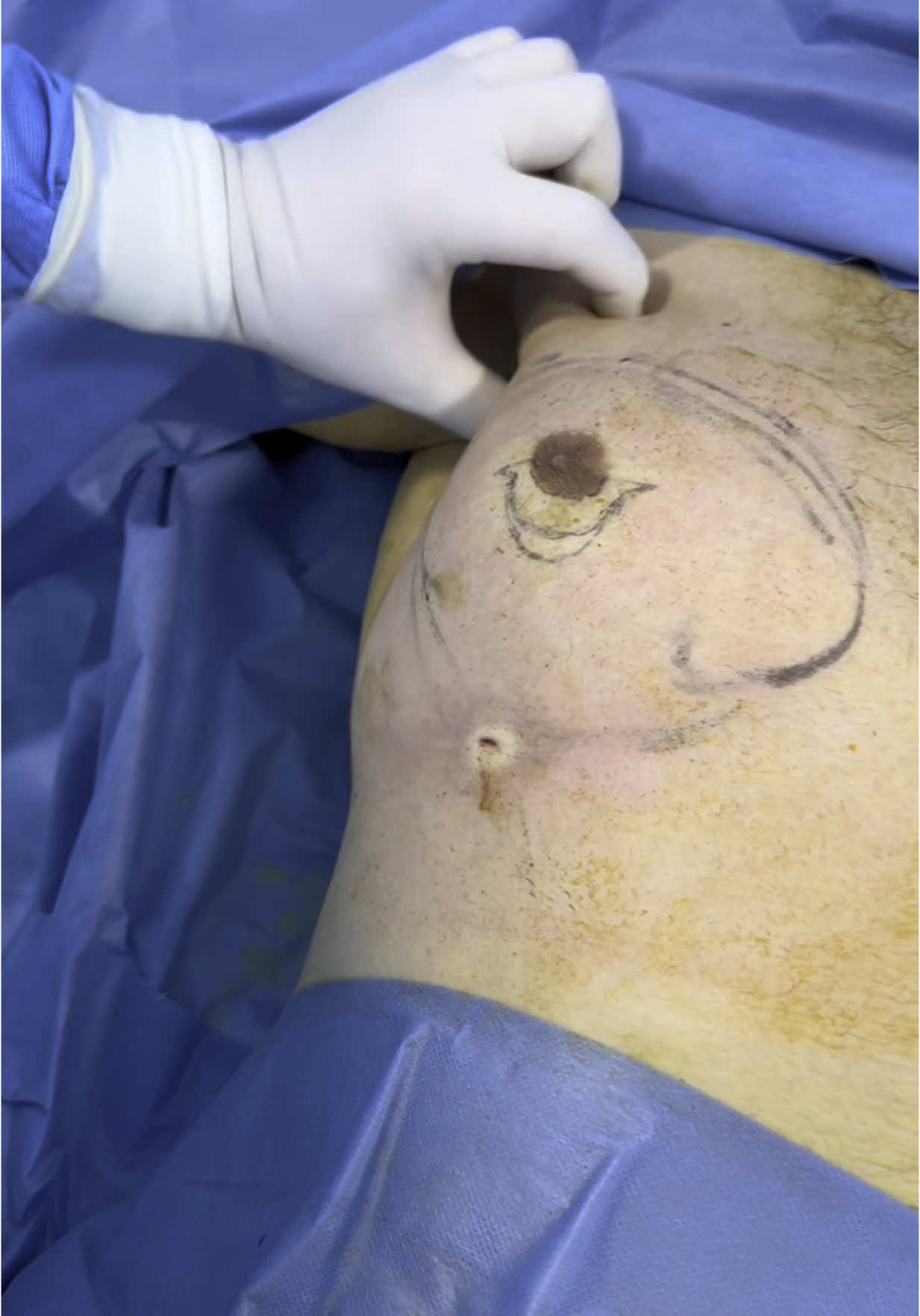 #gynecomastie #gynecomastia #lipomastie #التثدي_عند_الرجال #liposuccion #liposuction #شفط_الدهون 