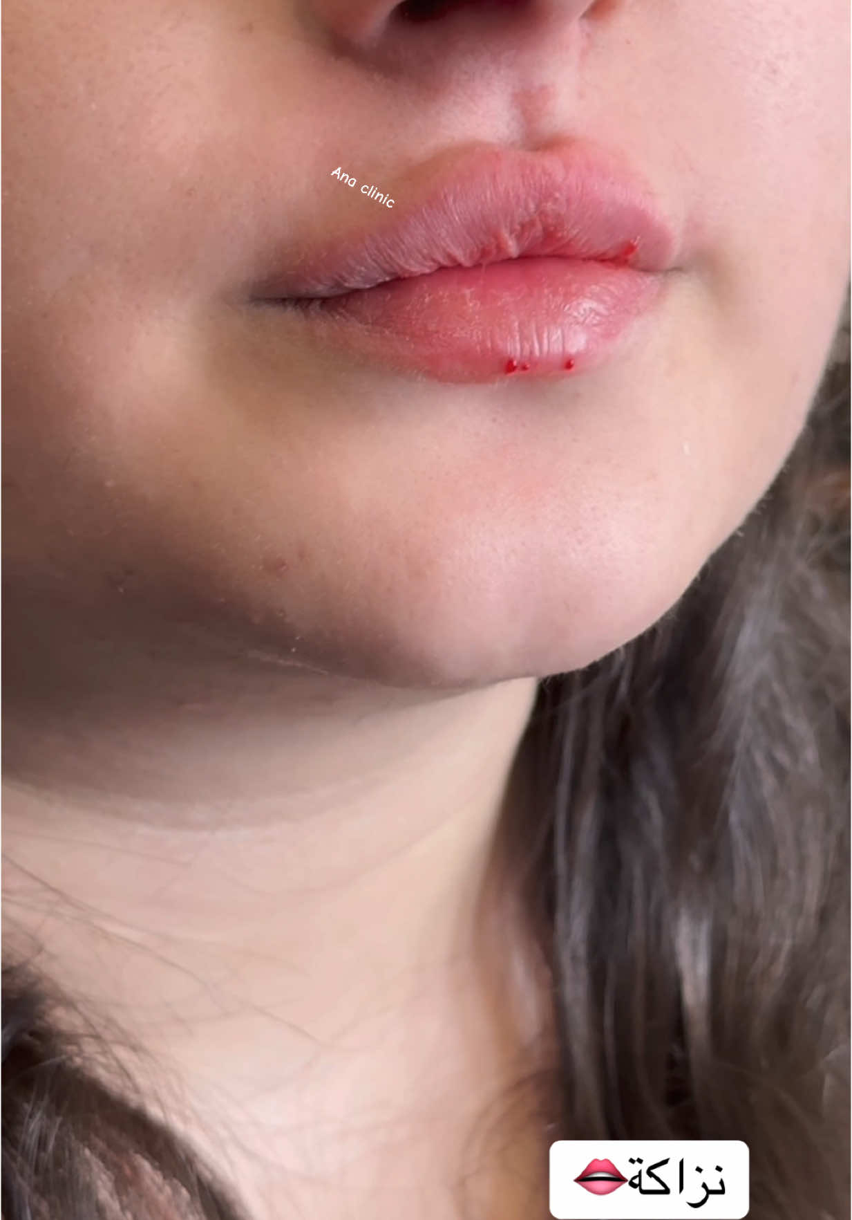 #explore #lipfiller #viral#fyp #viralvideo 