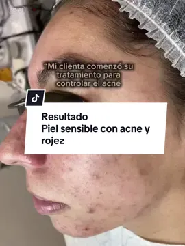 Piel sensible con acne y rojez #soloskinstudio #acnespecialist #ancetreatments #nashvillefacials #nashvilleskincare #nashvilleskin #nashvillemedsp #reveskin #dermapen4 #acnescars #acneproblems #acnejourney #acnesolution #acnefighter #lafacialista #nashvilleacnespecialist