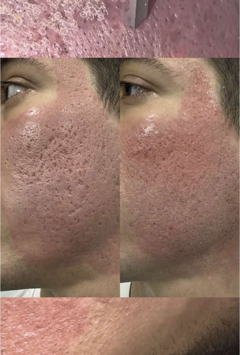 Amazing Acne Scar Transformation with our fractional CO2-Laser!✨ #co2laser #laser #transformation #acne #scar #acnescar #plasticsurgery 
