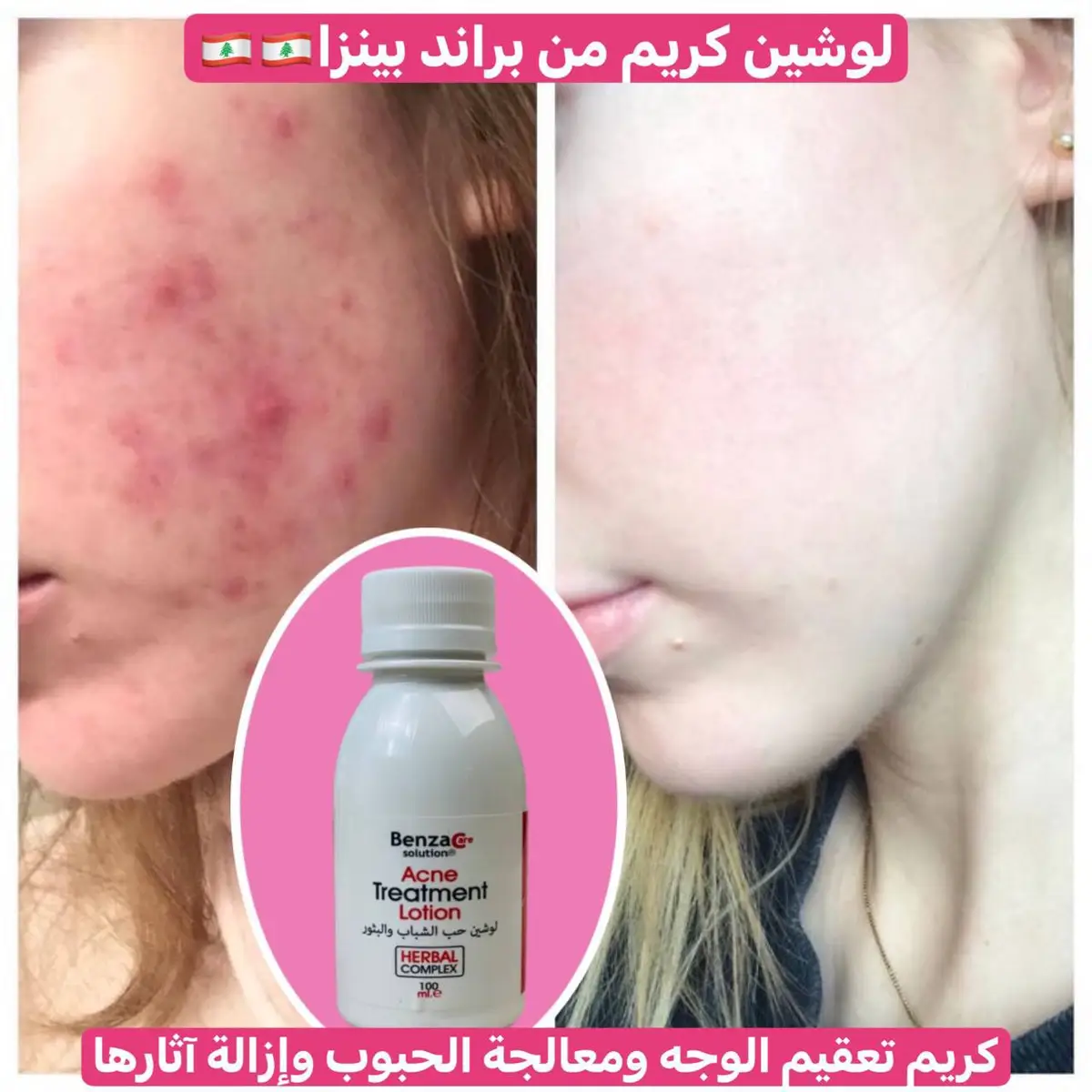 #زيونه_شارع_الربيعي #بغداد #العراق #لايك__explore___ #اكسبلورررررررررررررررررررر #متابعة   لوشين كريم علاج حب الشباب والبثور وآثارها من شركة بينزا كير العالمية 🇱🇧🇱🇧 كريم براند بينزا🇱🇧💯 السعر 15 الاف