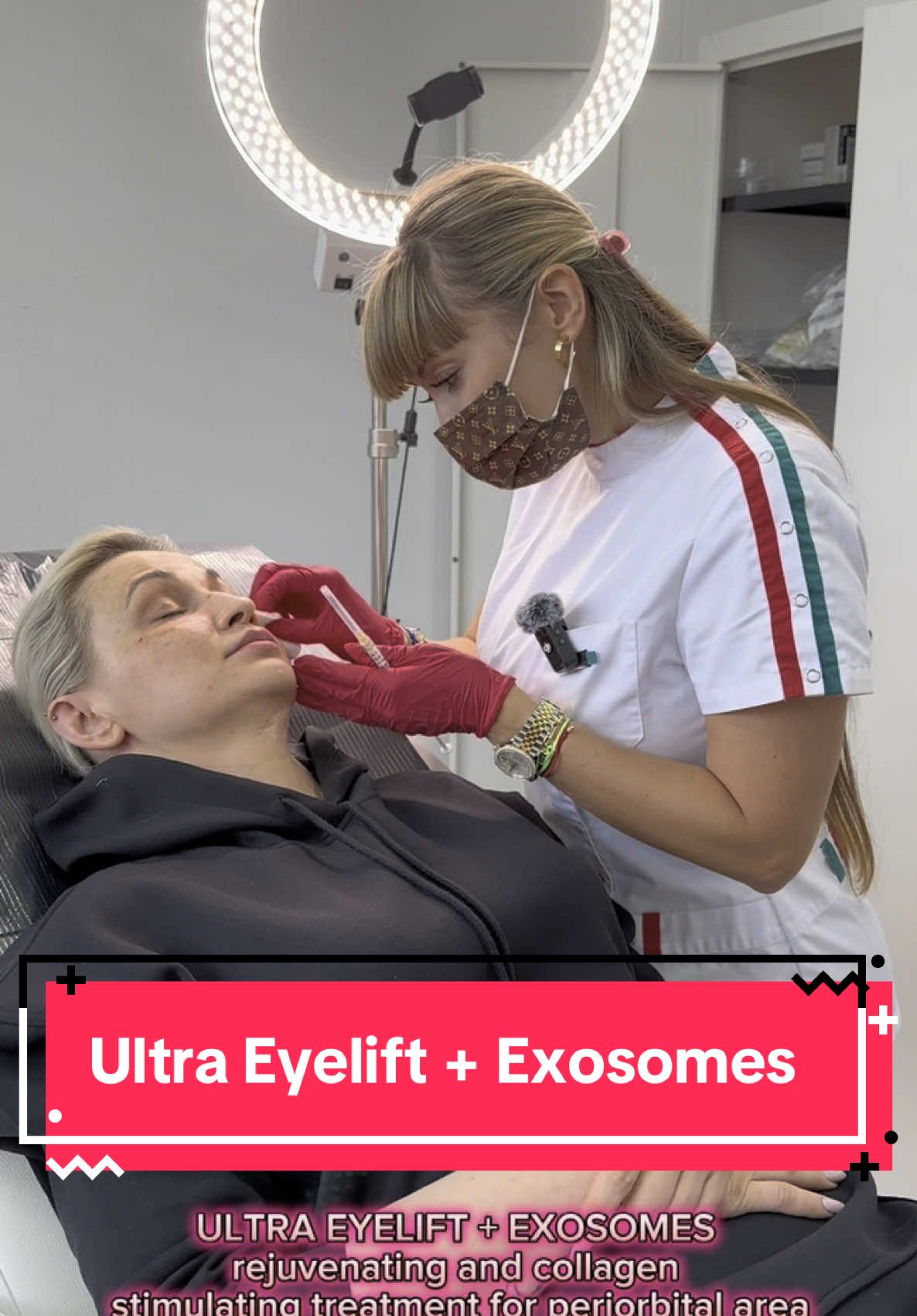 🫣Tired of looking tired? Your eyes deserve a second youth! ✨Discover our exclusive ULTRA EYELIFT + EXOSOMES treatment — the ultimate rejuvenation protocol for the periorbital area. ✔️ Smooths fine lines and wrinkles ✔️ Reduces puffiness and dark circles ✔️ Stimulates collagen and elastin ✔️ Brightens and tightens delicate under-eye skin ✔️ Visible results after just one session! 🧬Exosomes enhance the regenerative power of Ultra Eyelift by working on the extracellular matrix level, restoring firmness and radiance from within. 🌸Let your eyes reflect your energy, not your exhaustion. 📲Now available at EXITO BEAUTY CLINIC. Book your consultation today! ⸻ 🫣Müde Augen? Verleihen Sie Ihrem Blick neue Frische! ✨Entdecken Sie unser exklusives ULTRA EYELIFT + EXOSOMEN Treatment – die hochwirksame Kombination zur Verjüngung der Augenpartie. ✔️ Glättet feine Linien und Fältchen ✔️ Reduziert Tränensäcke und Augenringe ✔️ Stimuliert Kollagen- und Elastinproduktion ✔️ Strafft und hellt die empfindliche Augenhaut auf ✔️ Sichtbare Ergebnisse schon nach der ersten Behandlung! 🧬Exosomen verstärken die Wirkung des Ultra Eyelift, indem sie auf extrazellulärer Matrixebene wirken – für sichtbar festere, strahlendere Haut. 🌸Lassen Sie Ihre Augen jugendlich strahlen – nicht müde wirken. 📲Jetzt bei EXITO BEAUTY CLINIC – buchen Sie Ihre Beratung! ⸻ #UltraEyelift #Exosomes #UnderEyeRejuvenation #EyeRejuvenation #DarkCirclesTreatment #UnderEyeWrinkles #CollagenBoost #SkinRegeneration #AntiAgingEyes #FreshLook #YouthfulEyes #AestheticClinic #GlowUp #SwissAesthetics #SkincareInnovation #PeriorbitalRejuvenation #TiredEyesSolution #ExitoBeautyClinic #SkinTightening #NonSurgicalLift #ExosomeTherapy #LookRested #BrightEyes #EyeLiftTreatment #BeautyClinicSwitzerland #SwissBeauty #RegenerativeAesthetics #FirmSkin #GlowingSkin #AdvancedAesthetics