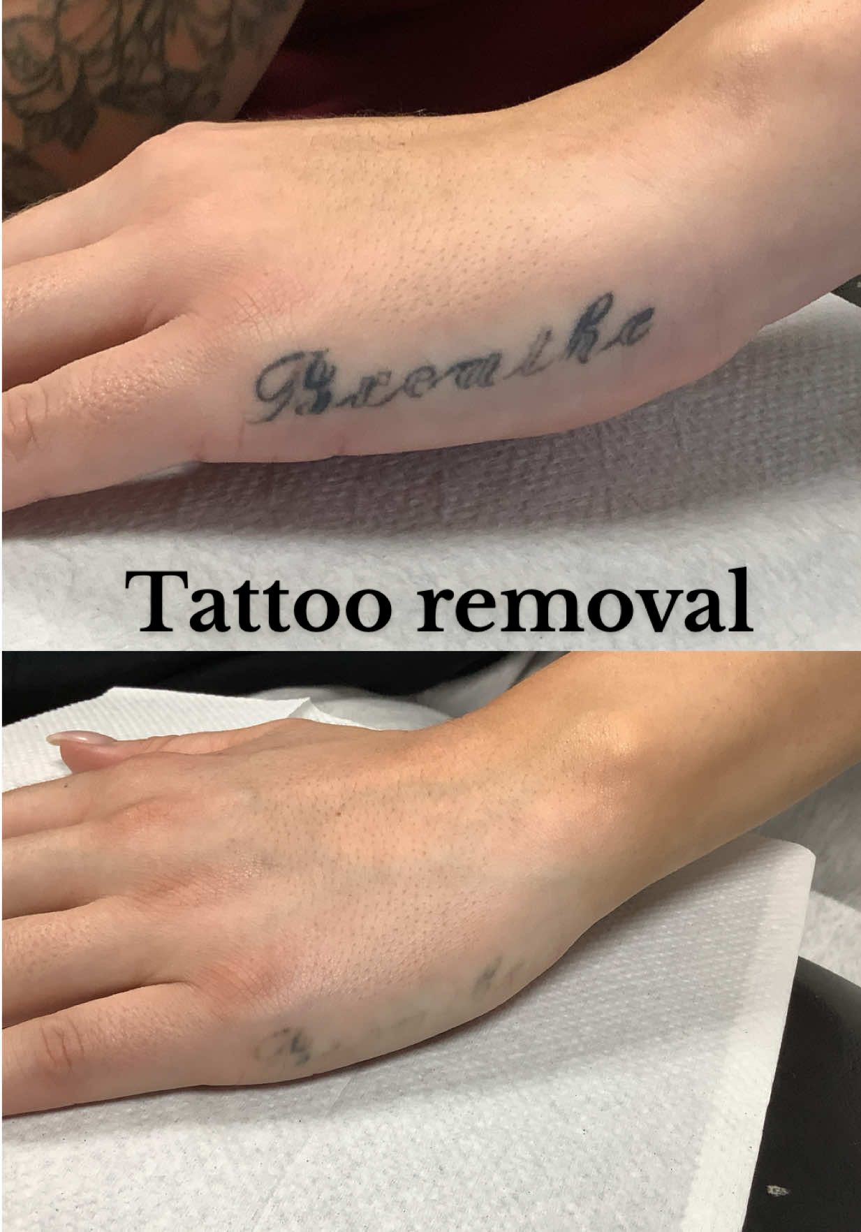 In a weird way I do feel like a weight was lifted off my shoulders🥹…I filmed my entire tattoo removal appointment sooo lmk if you guys want a pt.2?!? 🫶🏻🖊️ #tattoo #tattooremoval #storytime #grwmstorytime #laserhairremoval #BeautyTok #tattootiktok #SelfCare 