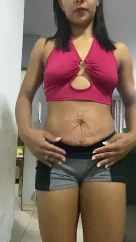 #cremeadeus #estrias #estriasposgestacao #autoestima #estriasbrancas 