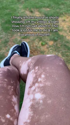 Whew deep breath I did it yall 👏 #vitiligo #roundofapplause #ididit #selfconfidence #michealjackson 