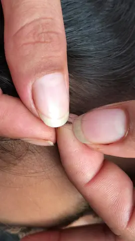Remove lice #😂😂😂 #😱😱😱omg #tripofobia #😭😭😭 #liceRemoval #lice #🤮🤮🤮 #😨😰🥶 