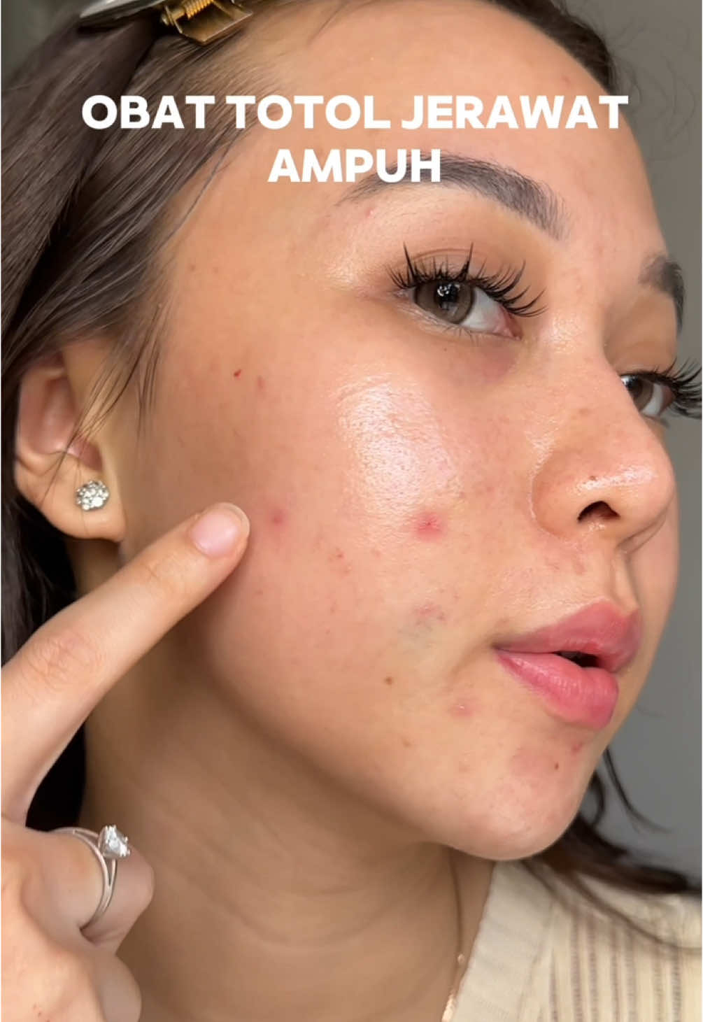 paling ampuh kalo udh pake ini besoknya jerawat langsung kering #Obattotoljerawatampuh #obattotoldojako #serumacne 