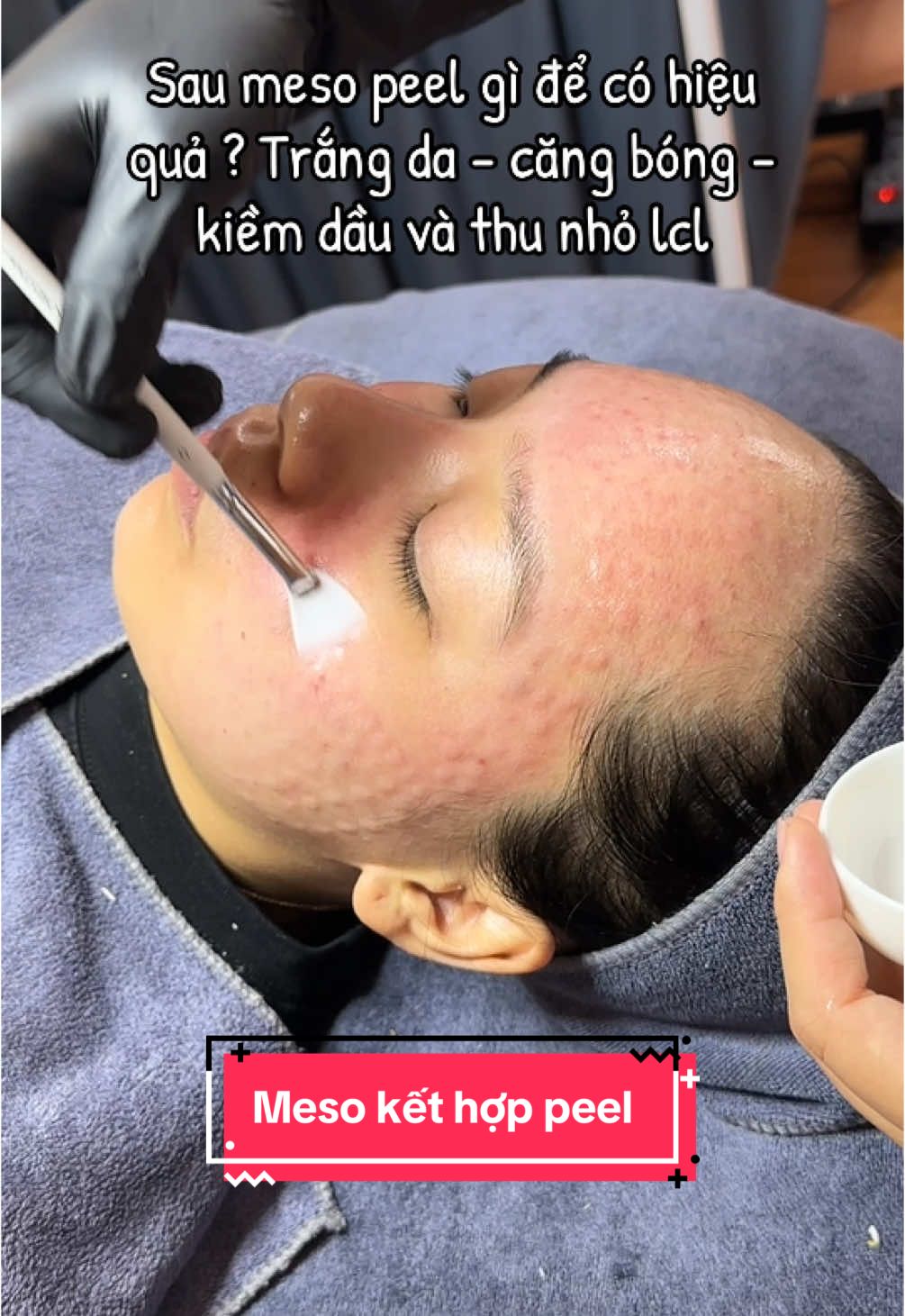Sau meso peel gì để x5 sự đẹp này ? #xh #dmp #peelda #duocmypham #meso #spabacninh #mesotrangda #mesopeel #spa 