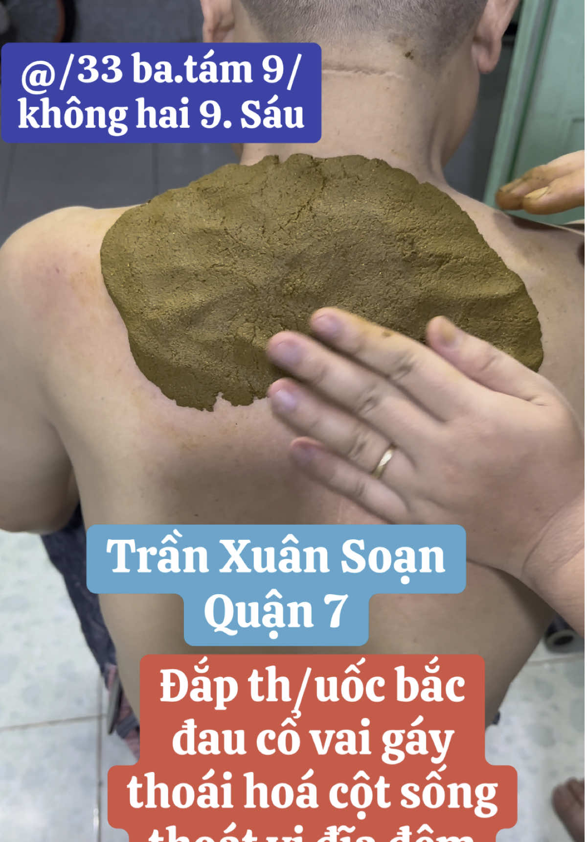 Đắp th/uốc bắc điều trị đau cổ vai gáy, thoát vị đĩa đệm, thoái hoá cột sống chèn ép rễ thần kinh.#yhcthuynhngocphuoc #caodapxuongkhophuynhngocphuoc #quận7 #thoatvidiadem #thoaihoacotsong #gaicotsong #daucovaigay 