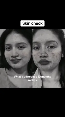 #duet with @glowjournalmamata Dark spots didn’t disappear in a day—this is 10 months of showing up and staying consistent🙂 #darkspots #darkspottreatment #acne #acneskin #acneproneskin #acneskincare #acnefighter #cysticacne 