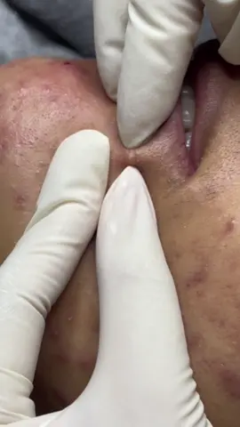 Quá tr nhiều luoon mn ơi , ai muốn lấy nhân mụn liên hệ Quỳnh #laynhanmunchuanykhoa #nặnmụn #Trị_mụn_Mỹ_Tho #QuỳnhBeautySpa 