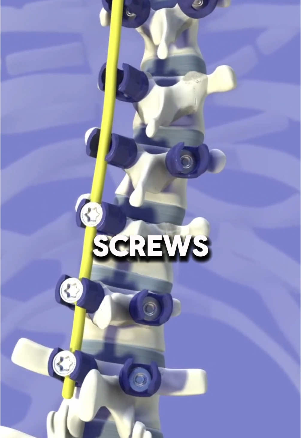 From curvature to correction — witness how scoliosis surgery realigns the spine and transforms lives. Precision. Power. Possibility. #spinereset  #ScoliosisSurgery #SpineSurgery #OrthopedicCare #BackStraightening #MedicalTikTok #LifeChangingSurgery #ScoliosisAwareness #DoctorExplains #HealingJourney #SurgeryTransformation #SpinalHealth #LearnOnTikTok