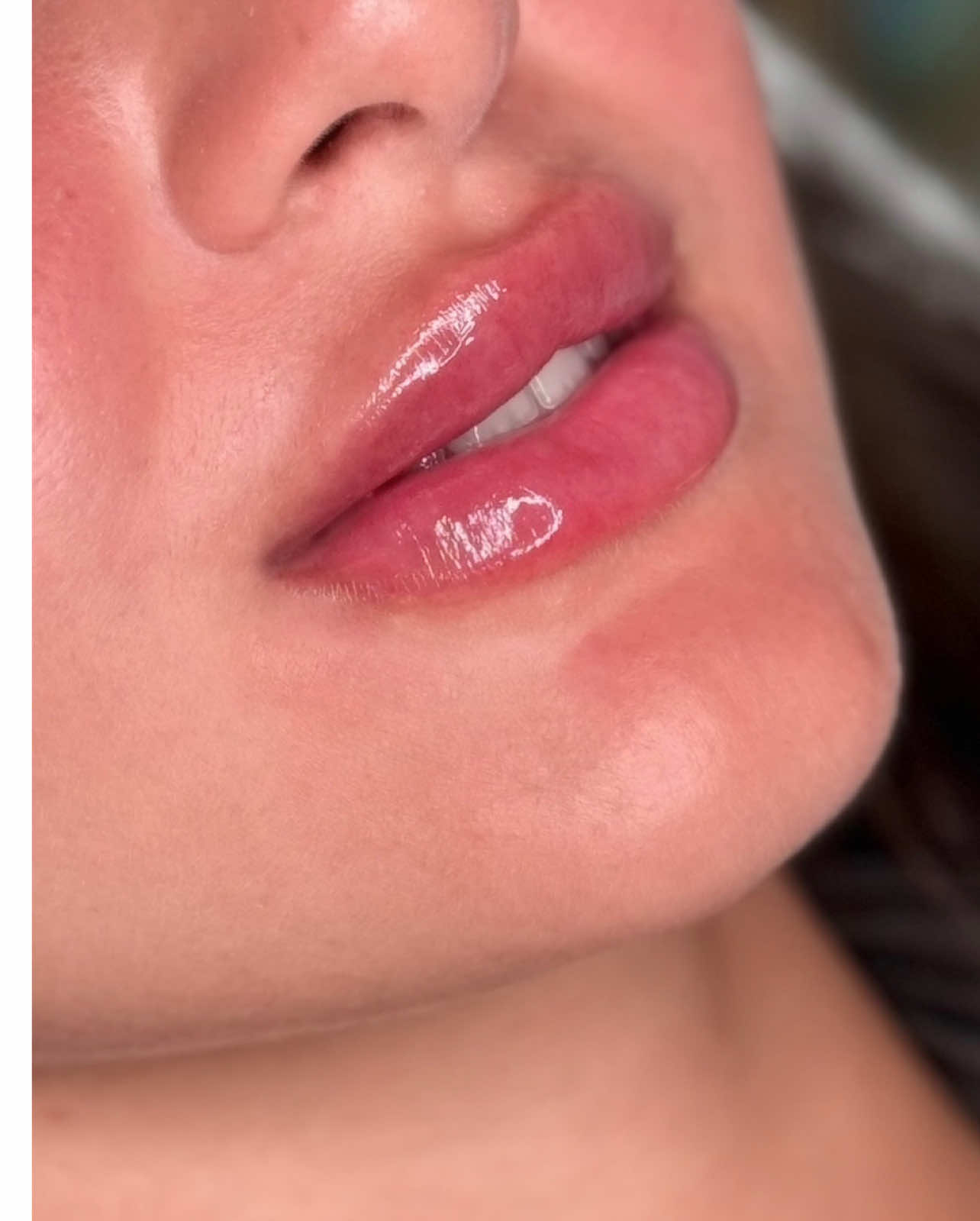 فيلر ناعم، طبيعي، وأنيق… شفايف بتتكلم بدون كلام ✨👄 . . . . #فيلر_شفايف #شفايف_طبيعية #عيادة_تجميل #جمال_ناعم #فيلر_طبيعي #شفايف_روسية #فيلر_الشفايف #Lip #شفايف_باربي #fillers💉 #filler #شفايف_وردية #الشعب_الصيني_ماله_حل😂😂 #marwashoaib #كنتور_شفايف #شفايفك_اذا_سويتي #فيلر_لابراز_الدقن #فيلر_وبوتوكس_الرياض #فيلر_كونتور #lipflip 