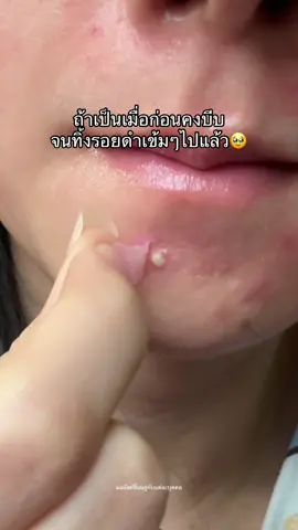 เลิกกัํกเลิกบีบบบ เพราะแค่แปะชับบี้ก็ดูดแฟ้ดดด👀 #รีวิวบิวตี้ #เรื่องผิว #แผ่นแปะสิวชับบี้ #ชับบี้ 