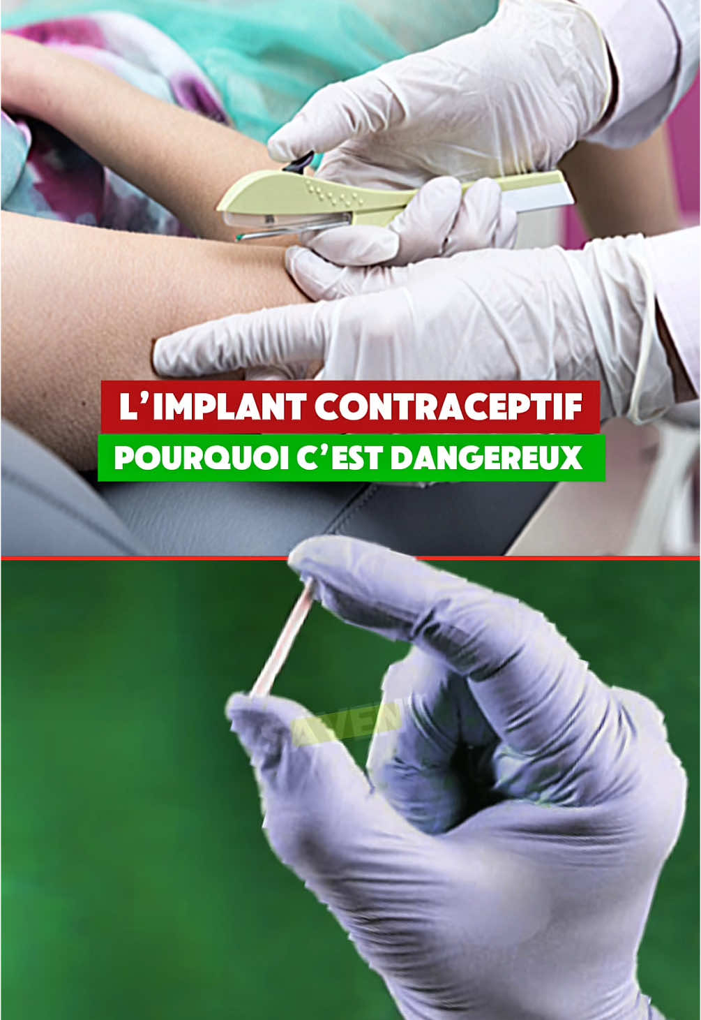 L’implant contraceptif pourquoi c’est dangereux #implantcontraceptif #causes #symptomes #prevention #medical #medecine #medicina #anatomy #3d 