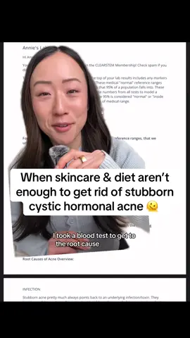 My skincare hot take: Spironolactone is a BAND AID solution and your acne is gonna come back when you stop taking it 🤷🏻‍♀️ If you talk with a derm about recurring hormonal cystic acne, the recommendation is usually always Spironolactone which is a high level way to regulate your hormones. It can also impact your fertility and sometimes it's required to take birth control alongside Spiro. But Spiro + BC are both only band aid solutions (and a lot of admin tbh) that are covering up the true problem. I definitely had some sort of internal hormonal imbalance that kept causing recurring acne that both skincare and a healthy diet weren't fixing. So I wanted to get labwork done and that's when I found that @CLEARSTEM Skincare , which is a skincare brand born out of struggles with acne, offered an Acne Lab Panel test which is a blood test via @Rupa Health where holistic practitioners take a look at your bloodwork to see if there is anything off internally.  And depending on what's going internally, it may take multiple rounds of labwork + supplements to clear any imbalances. I got recommended a regimen of supplements to address my underlying imbalances and my breakouts aren't completely gone but they are SO much smaller and more infrequent!  I'm taking a break to focus on freezing my eggs, then I am going to evaluate how my skin is after and may do another round of labwork. Clearstem gifted me the Acne Lab Panel (retails for $500) but I paid $200 myself to speak with a Clearstem Practitioner to understand my results more.  The Acne Lab panel is 100% worth it as this isn't even something I could get from my dermatologist and after egg freezing, I'll probably do a second round of the acne lab panel (and purchase it myself). Let me know if you have any questions! Should I make a YouTube video on this? 👀 #bloodwork #clearstem #hormonalacne #cysticacne #rootcausemedicine #spironolactone #acnetips #acnejourney #hormonalimbalance 