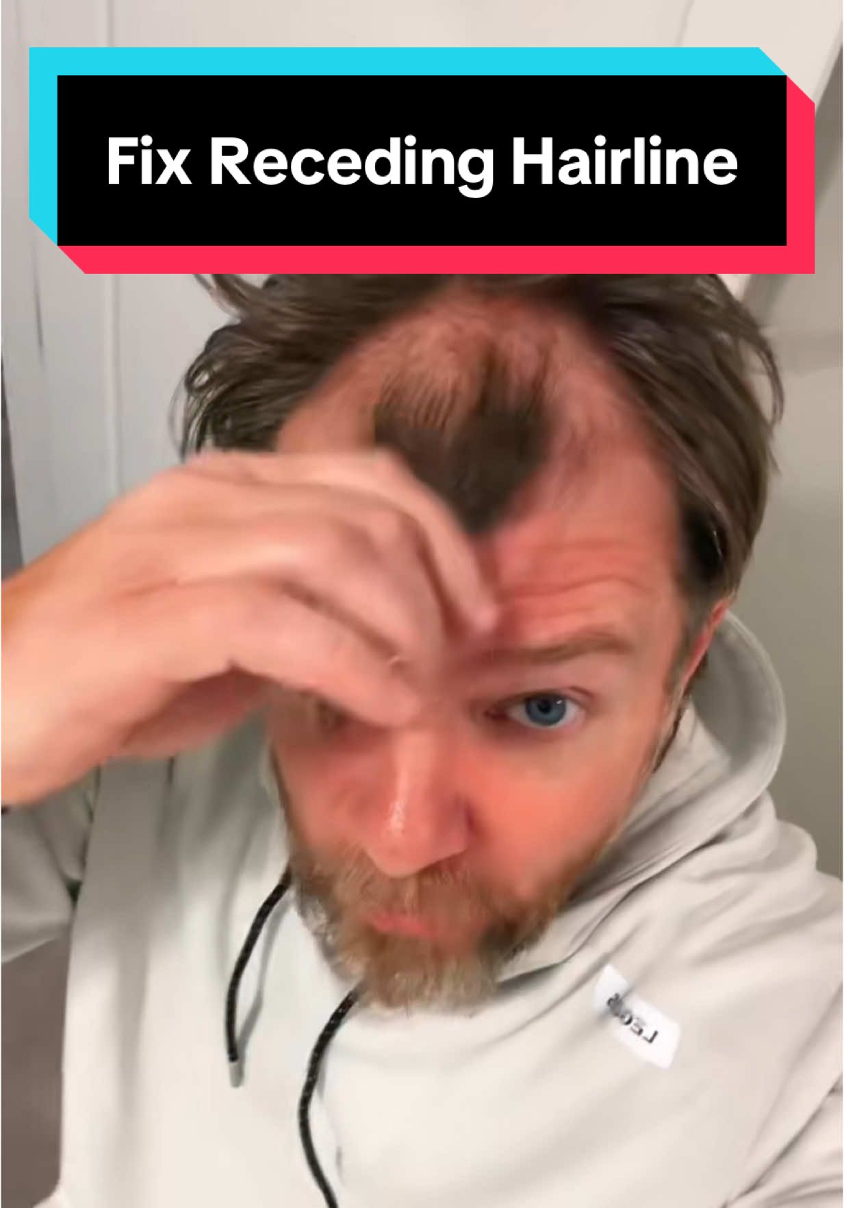 Fix receding hairline. Cover bald spot in seconds. #recedinghairline #menshairloss #balding 