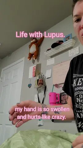 the last 2 days have been hell. #lupus #jointpain 