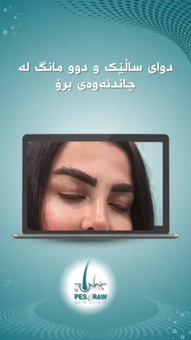 ئەنجامی چاندنی برۆ دوای یەکساڵ 07718156565 