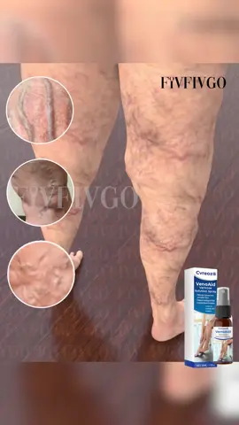 🚨 Verabschiede dich von Krampfadern und Beinschmerzen mit Cvreoz® Varizen-Spray! 💪 ✅ Reduziert Venen & Schwellungen in nur 4 Wochen! ✅ Natürliche Inhaltsstoffe für schnelle Linderung 🌿 ✅ Klinisch bewiesene Ergebnisse! Sprayen, einmassieren und den Unterschied spüren! Starte noch heute! ✨ #Krampfadern#Schmerzlinderung#SchöneBeine