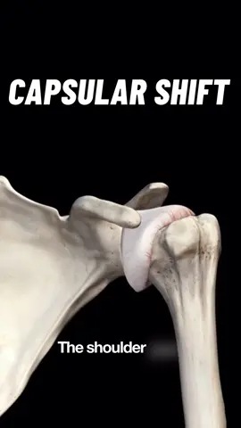 A capsular shift operation is a surgical procedure used to treat shoulder instability, typically when the joint capsule has become stretched or redundant. This can occur due to repetitive dislocations, chronic subluxations, or congenital laxity. The goal of the operation is to reduce the volume of the glenohumeral joint capsule by tightening it, thereby restoring stability without over-constraining the joint. The surgeon achieves this by creating a flap in the capsule, overlapping and suturing the tissue to shift and tighten the capsule, effectively reinforcing the anterior, posterior, or inferior portions depending on the direction of instability. This operation can be done arthroscopically or through open surgery, with arthroscopic techniques generally being preferred today due to less soft tissue disruption and quicker initial recovery. It’s most commonly performed in patients who have generalised ligamentous laxity or those who’ve failed conservative management and have persistent symptoms of instability. Recovery from a capsular shift procedure varies depending on the individual and the extent of the instability addressed, but generally, the arm is immobilised in a sling for around four to six weeks post-operatively to allow the capsule to heal in the tightened position. Physiotherapy usually begins early with passive range of motion exercises, progressing to active movements and eventually strength work. Most patients can expect to regain full function by around four to six months, but return to contact sports or high-demand activities may take closer to nine months. Full recovery is gradual, and regaining stability without compromising range of motion requires careful rehabilitation and adherence to post-op guidelines.  #osteopaths #shoulderpain #rotatorcuff #osteopathy #anatomy 