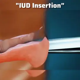 #IUDInsertion #IUD #BirthControl #SafeBirthControl #EffectiveBirthControl #FamilyPlanning #ReproductiveHealth #WomenHealth #BodyAutonomy #Contraception #IntrauterineDevice #Healthcare #WomenEmpowerment #PersonalChoices #MenstrualHealth #HealthEducation #IntimateWellness #SafeSex #knowyouroptions #foryoupage❤️❤️ #videoviral 