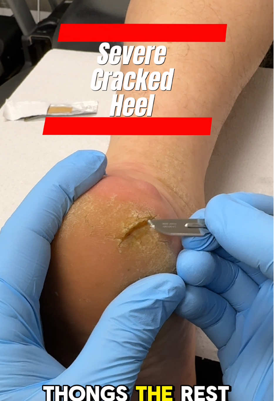 Badly cracked heels on a plumbers foot. Regular treatment and moisturizer will help ergonx.com.au #callus #corn #podiatrist #australia #satisfying #ergonx #footpain