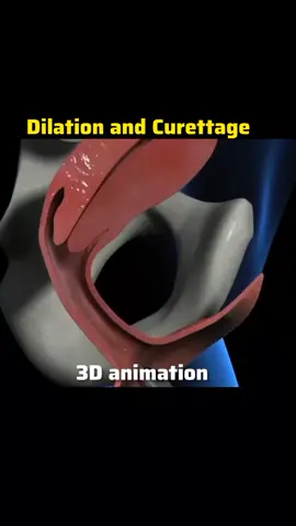 Dilation and curettage is a medical procedure that dilates the cervix and surgically removes tissue from the lining of the uterus by scraping or scooping. The D&C gynecologic procedure is used for treatment, diagnostic and therapeutic purposes. #DilationAndCurettage #DilationAndCurettageAnimation #3DAnimation #MedicalAnimation #HealthcareEducation #GynecologicalProcedures #WomenHealth #PatientEducation #SurgicalProcedures #AnimatedExplainer #MedicalIllustration #UnderstandingDandC #HealthAwareness #SurgeryAnimation #3DMedicalGraphics #Women'sHealthEducation #HealthcareVisuals #AnatomyAnimation #CurettageExplained#foryoupage❤️❤️ #videoviral 