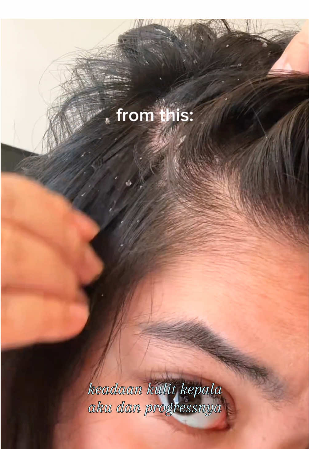 akhirnya nemu yang cocok lagi teh😭😭😭😭 @erhair_official #ShampooAntiKetombe #ScalperfectShampoo 