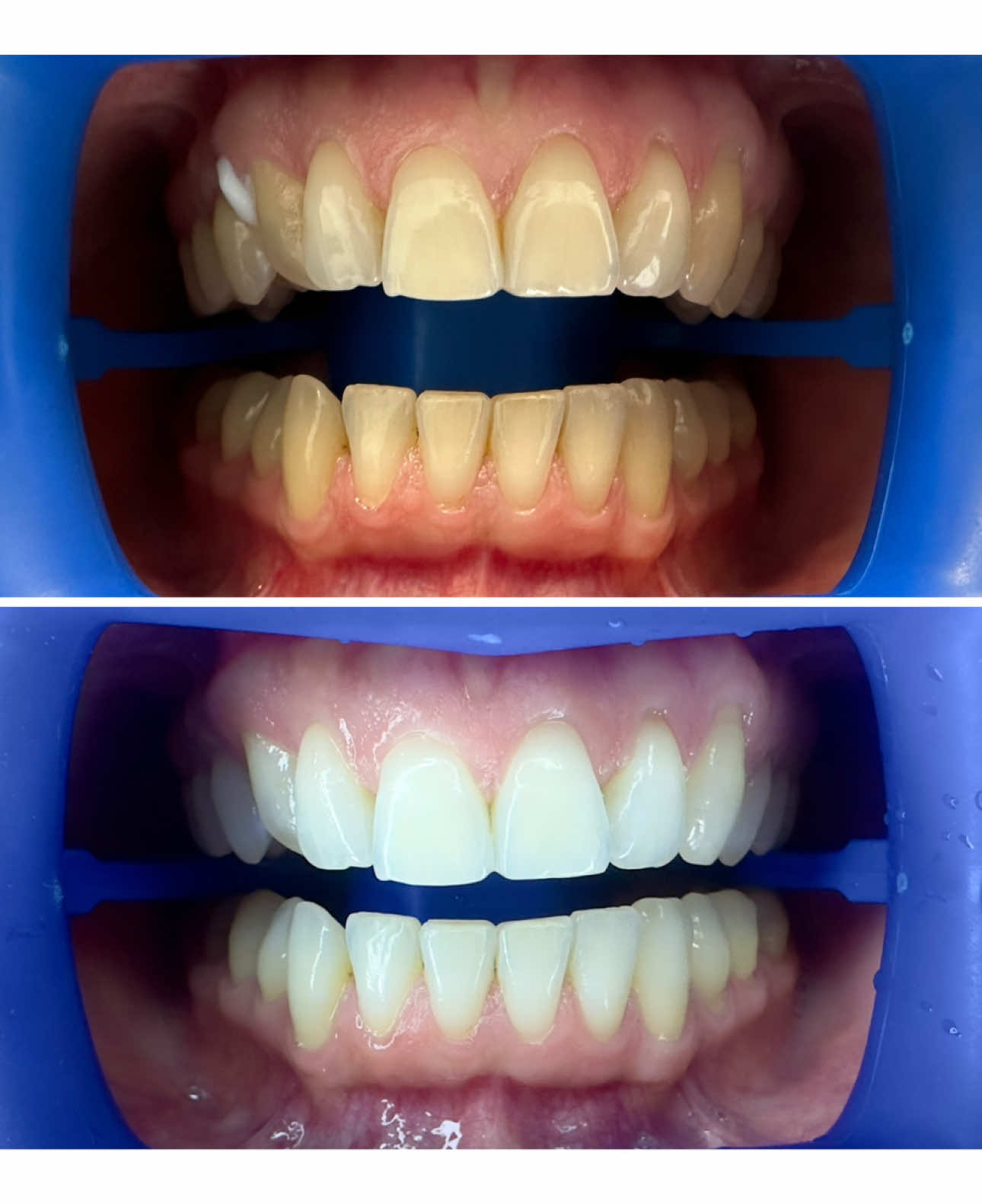 Zbardhje pa asnje shqetesim klinik, me efekt zbardhues maksimal  Produkti me cilesor Zoom Philips 🇺🇸🦷💎  #whitening #zoomphilips #philipszoomwhitening #sbiancamento 