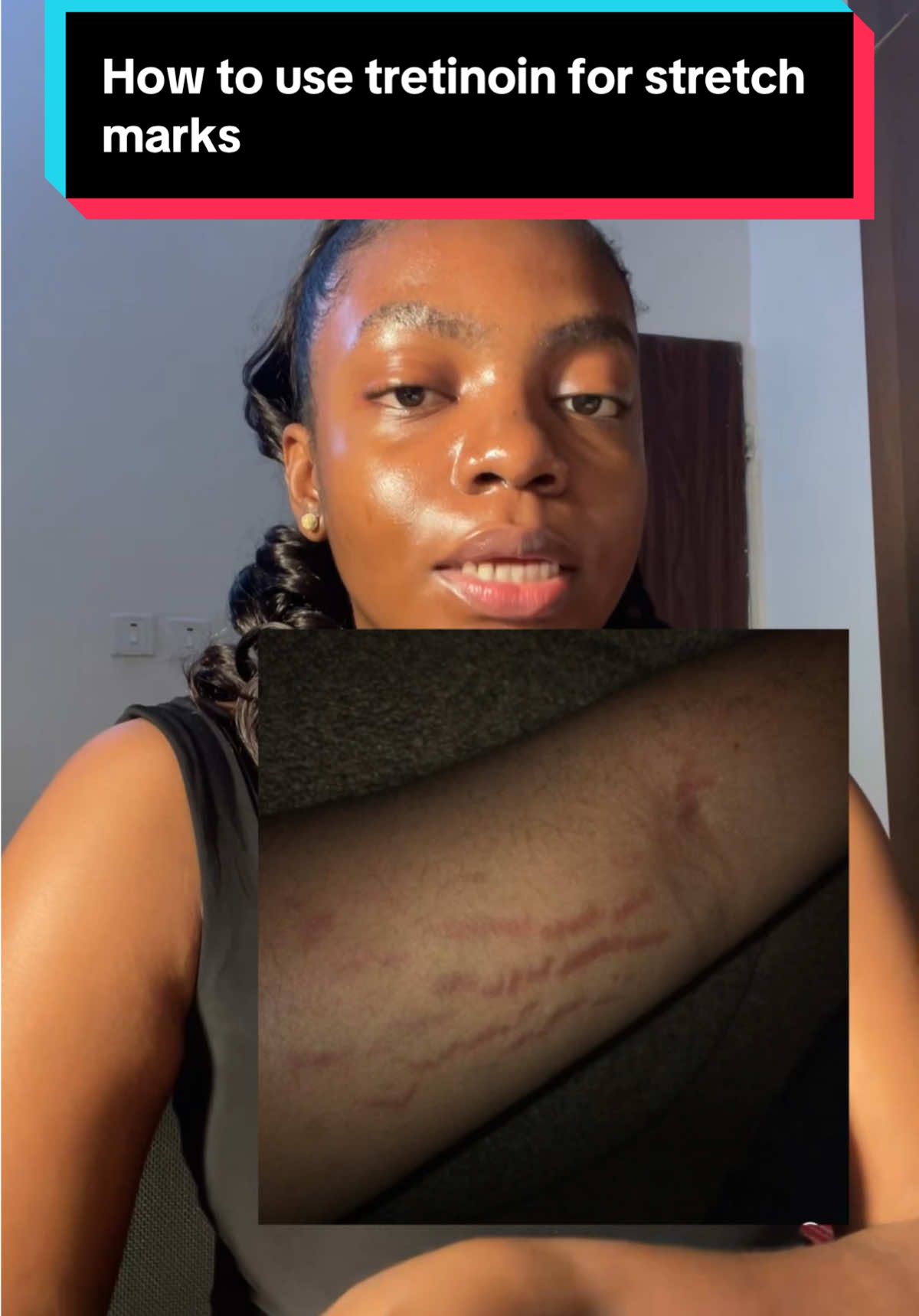 How to use tretinoin to reduce the appearance of stretch marks.  #stretchmarks  #skintok   #skincaretips  #SkinCare101  #stretchmarkremoval  #tretinoin  #tretinoinforstretchmarks  #tretinoinjourney  #stretchmarksremedy 