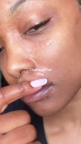Summer skin loading... #chemicalpeel #fypシ #skincare #peel 