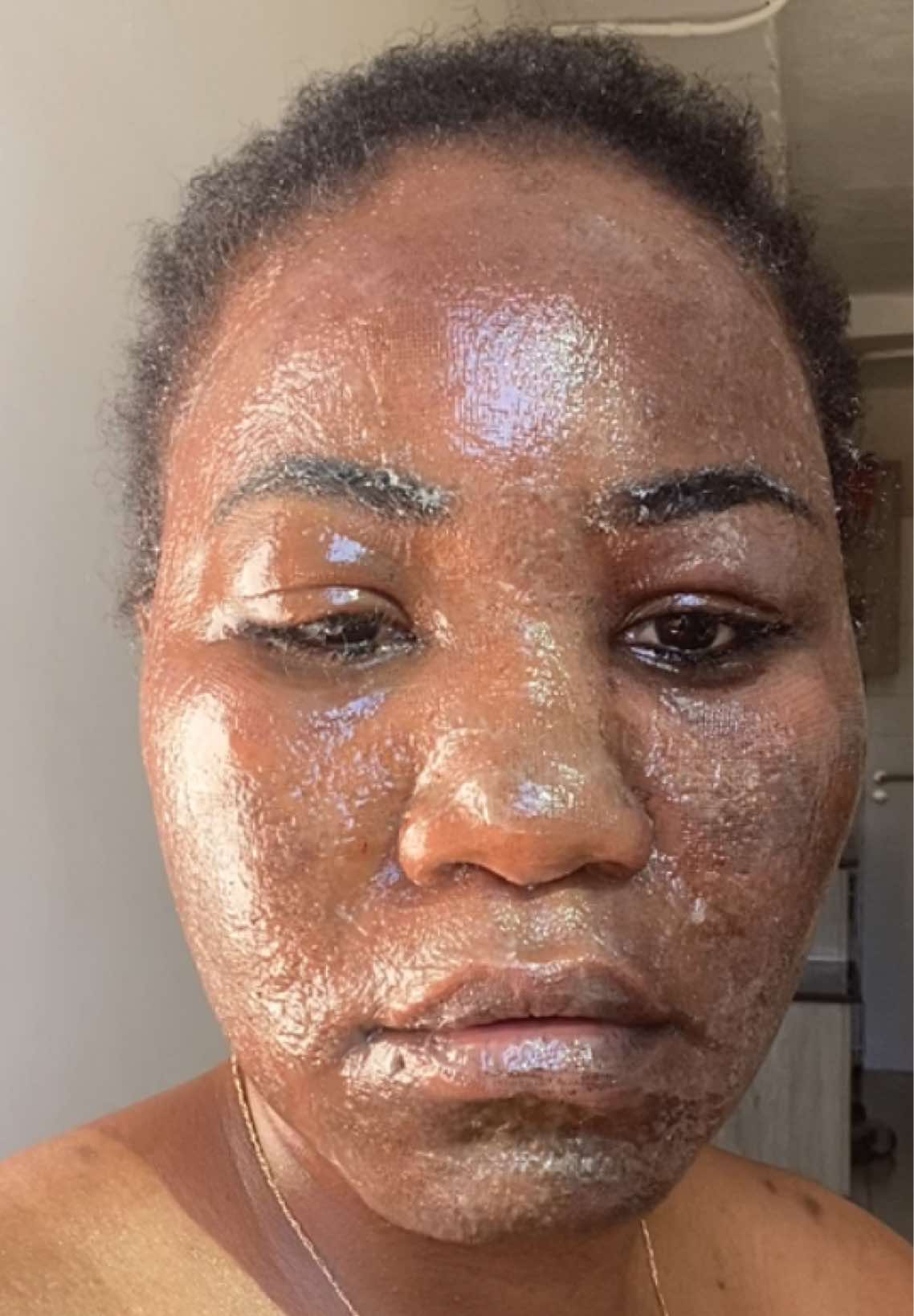 #laserco2franctional #laserco2 #skincare #routineskincare #darkchocolat #hypopigmentation #co2fractional_laser #gabontiktok🇬🇦 #congotiktok #francetiktok #maroctiktok_algerie_tunisie_tik_tok #tiktoksa #tiktoksouthafrica #tiktoksa #femmeafricaineetfièredelêtre💞 #beauté #dakar #pretoriasouthafrica🇿🇦 #johannesburg #libreville_gabon🇬🇦 