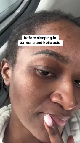 The BEST for hyperpigmentation 🙌 #darkspots #hyperpigmentation 