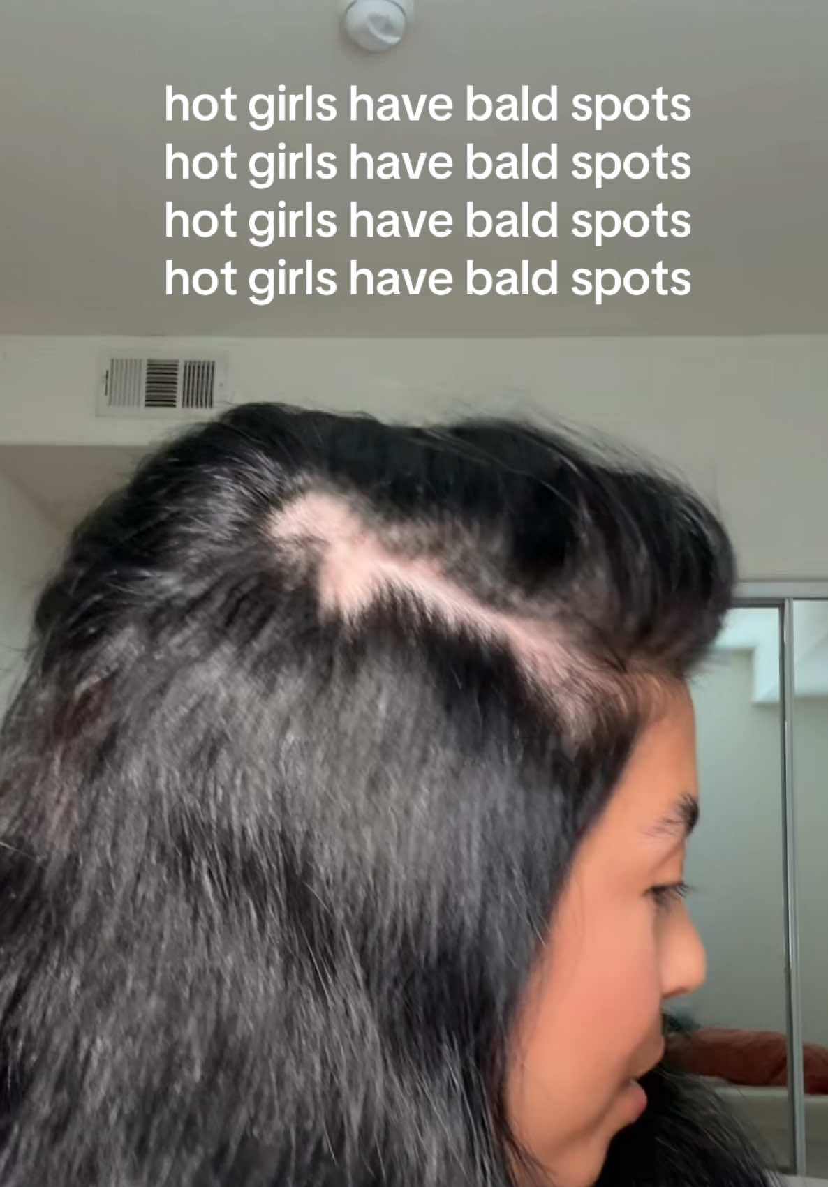 To all my bald baddies out there!!!! #hairloss #baldspots #balding #alopecia #hairregrowthjourney 
