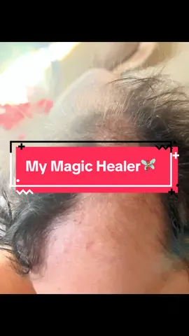 If yall want the whole protocol on how i helped my daughters eczema please leave me a comment below. #eczema ##mymagichealer##TikTokShop##babytok##healingtok##wildyamcream##herbalmedicine##herbs