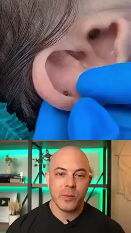 Derm reacts to a HAIRY situation! #dermreacts #doctor #doctorreacts #viral #satisfying #foryoupage #skincare #fypシ #healthy #pimplepop #ingrown #pimple