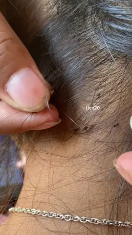 oh so many lice moving out 😱🗯️#omg #lice #liceremoval #treanding 