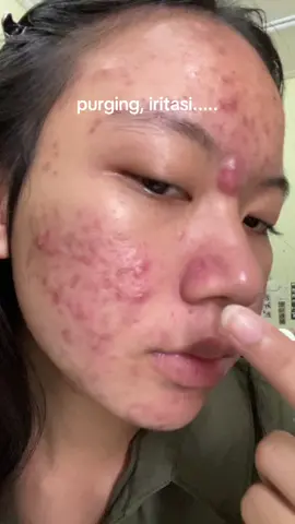trust the process and get the result, semangat pejuang jerawat!!! #acnefighter #acneproneskin #acneskin #acne #skincare #acneskincare #forebie 