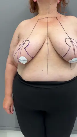 #antiagers #fyp #fypシ #greece #velimvasakis #breastreduktion #breastlift 