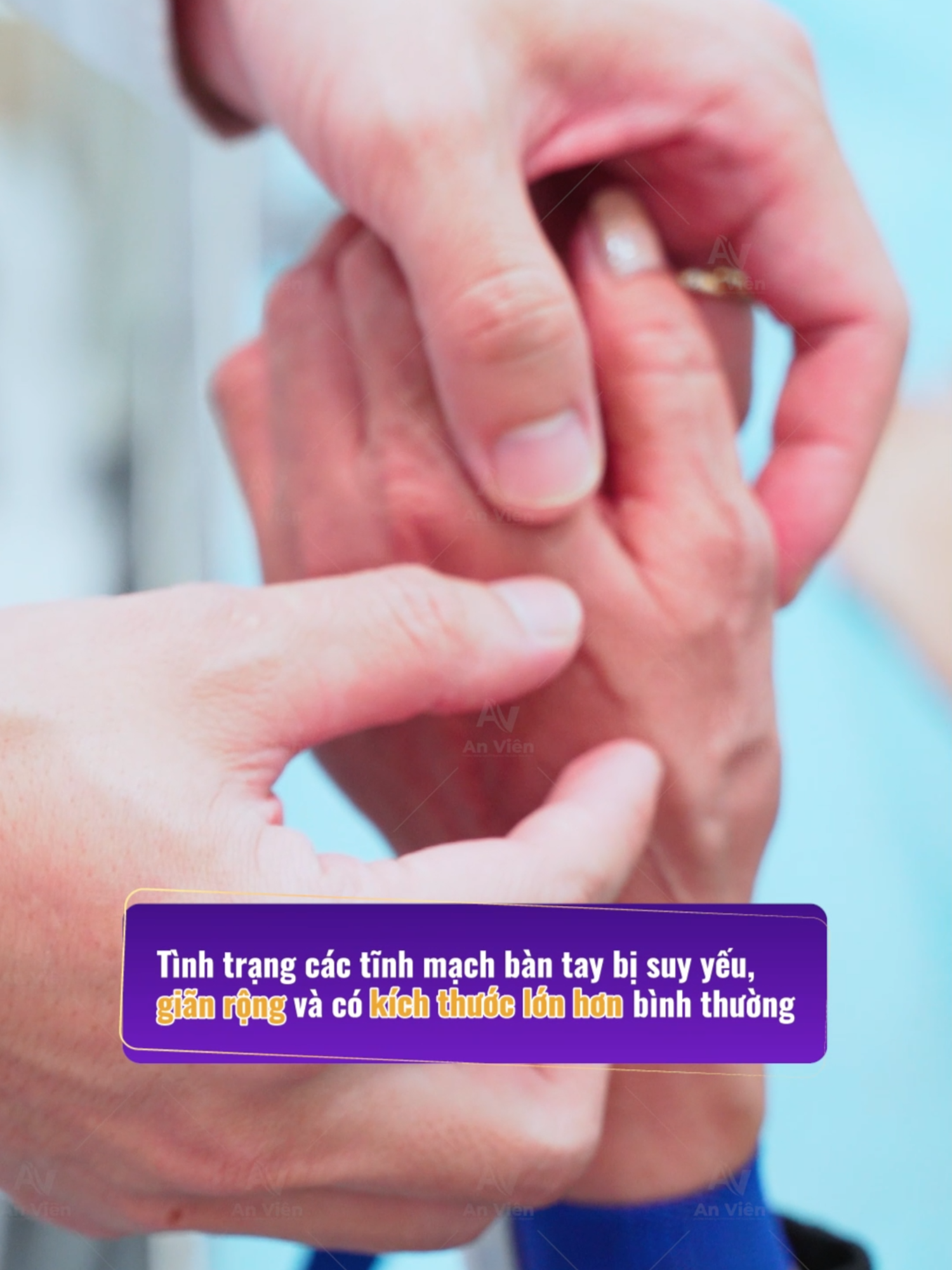 Suy giãn tĩnh mạch bàn tay , tay nổi gân xanh nổi ngoằn ngoèo #suygiantinhmach #tinhmachanvien #anvien