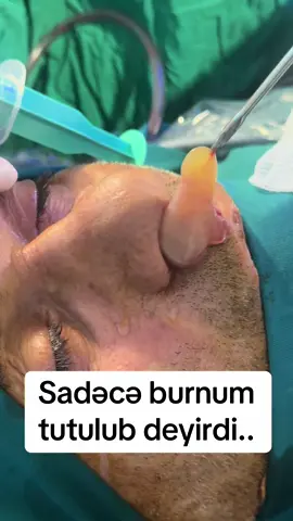 Yenə ağzınla nəfəs alırsan⁉️Bəlkə də səbəb burnunda gizlənib… Videoda gördüyünüz burun boşluğundan çıxarılan böyük polipdir. İllərlə bu adam nəfəs ala bilmədi,iy bilmədi,yuxuda boğulma (apnoe)yaşadı,hər gün yorğun oyandı Səbəb sadə,amma təhlükəli:polip. 🧠 Polip-burun boşluğunda və ya sinuslarda formalaşan xoşxassəli törəmədir. ❌ Öz-özünə yox olmur. 🧱 Əksinə-böyüyür,hava keçidini bağlayır,nəfəsi çətinləşdirir… Və nəticədə: ❗️daimi burun tutulması, ❗️qoxu itkisi, ❗️ xroniki sinusit, ❗️ yuxuda nəfəs dayanması(apnoe) ❗️ qəfil baş ağrıları  ❗️ümumi halsızlıq  🧬 Necə yaranır? Allergiyalar Xroniki burun-udlaq iltihabları Astma Genetik meyillik Tozlu mühit Zəifləmiş immun sistem ⚠️ Qorxulu olan nədir? Əksəriyyət bu əlamətləri normal qəbul edir. “🤷‍♂️Burnum tez-tez tutulur da…” “😷Yəqin tozdan oldu…” Amma bu gözəgörünməz problem illərlə nəfəsimizi əlimizdən alır. Və çox zaman gec aşkarlanır… 🔍 Sadə endoskopik baxışla polip aşkarlanması mümkündür. Vaxtında edilən müdaxilə həyat keyfiyyətinizi 180° dəyişə bilər. 🎬 Bu video sadəcə əməliyyat görüntüsü deyil. Bu–xəbərdarlıqdır.. Çünki nəfəs almaq-həyatdır. Və heç kim nəfəs üçün mübarizə aparmamalıdır.. #burunpolipi#nəfəsalmaqhəyatdır#tibbreels#realəməliyyat#sağlamnəfəs#azeritibb   #azərbaycansağlamlıq   #lormüayinəsi   #tibbimaarifləndirmə   #səndəpaylaş  