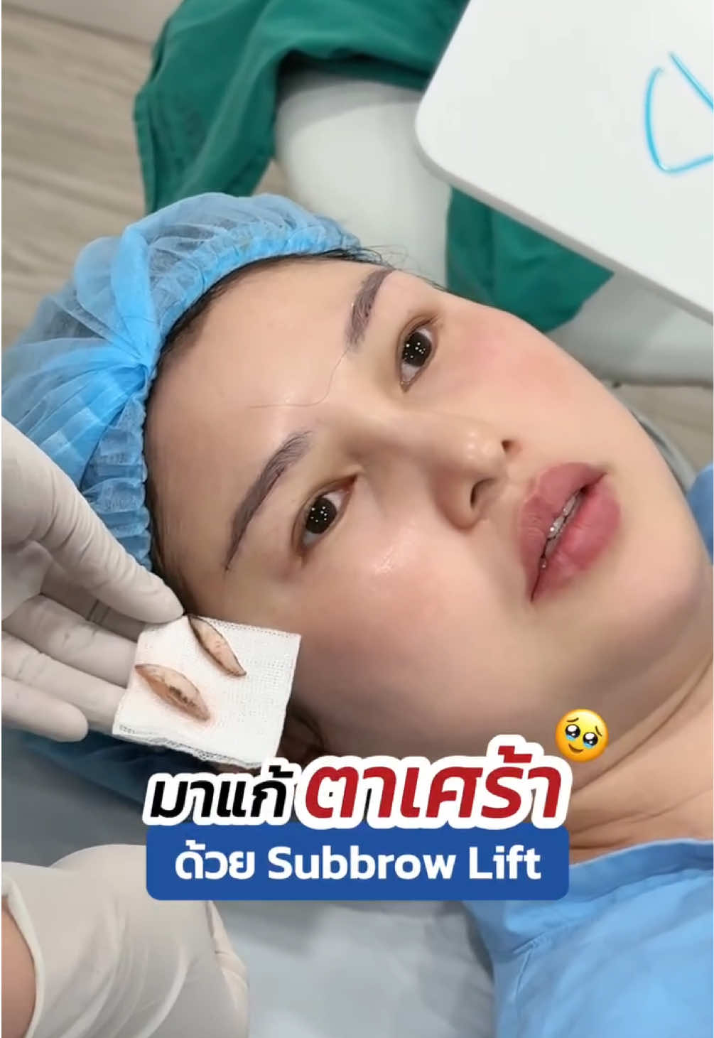 มาแก้ตาเศร้า  หางตาตก 🥹 ด้วย #subbrowlift #ซ่อนแผลใต้คิ้ว #ซ่อนไหมไร้รอยเข็ม #หมอสกาย  #จักษุแพทย์ #สกายคลินิก #skyclinic #ทำตาที่ไหนดี #ยกคิ้ว 
