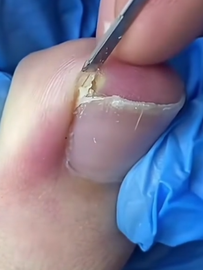 #unhaencravada #alivio #videosatisfatorio #satisfingvideo #ingrowntoenail #ingrowtoenailremoval 