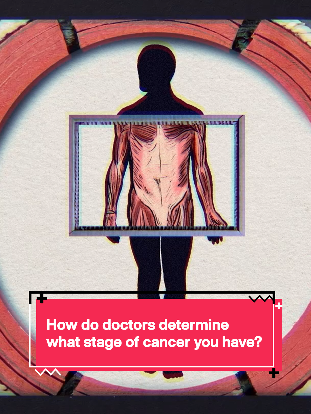 Each year, approximately 20 million people receive a cancer diagnosis. At that time, a patient usually learns their cancer’s stage, which is typically a number ranging from one to four. While staging is designed, in part, to help patients better understand what they’re facing, the number can be confusing. So, what do cancer stages actually mean? In this TED Ed animation, Hyunsoo Joshua No and Trudy Wu explain. #Cancer #cancerdiagnosis #prostatecancer #TEDEd #TEDTalk